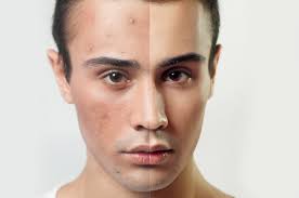 Deep Skin Care (Acne)